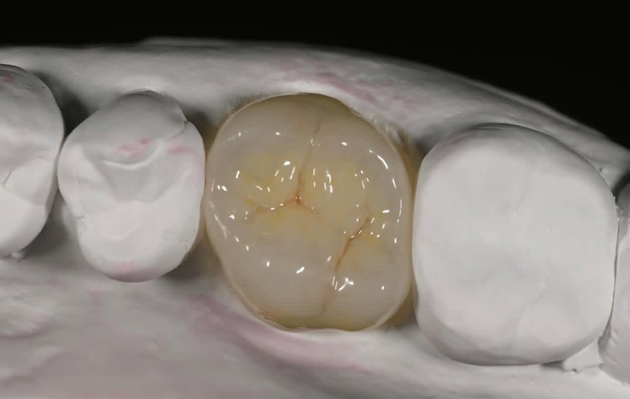 Aesthetic Restorations